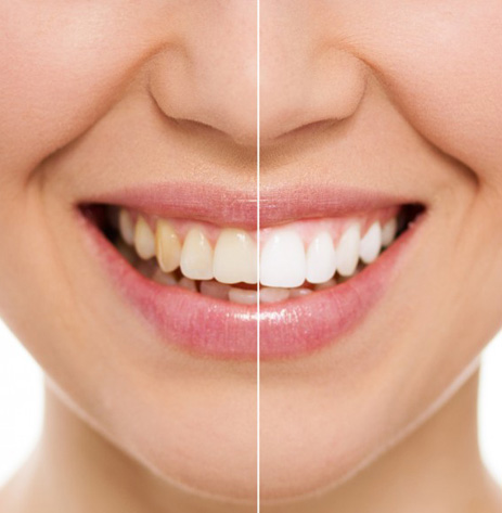 crest-whitestrips-example