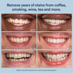 Auraglow-Teeth-Whitening-Kit-LED-Accelerator-Light-3