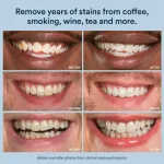 auraglow-teeth-whitening-gel-44-carbamide-peroxide-6