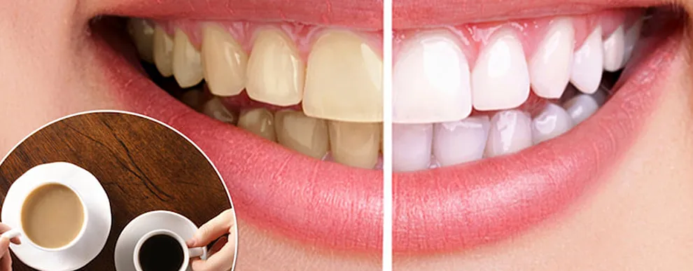 small-daily-habits-that-stain-teeth-causes-prevention-banner