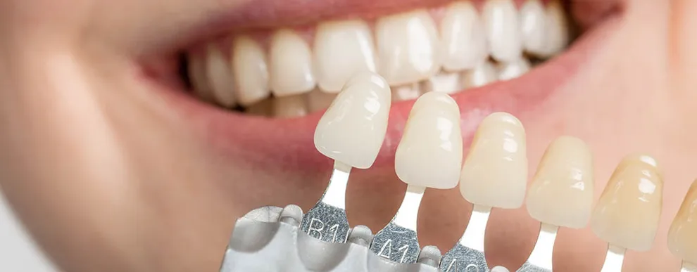 whitening-veneers-blog-banner
