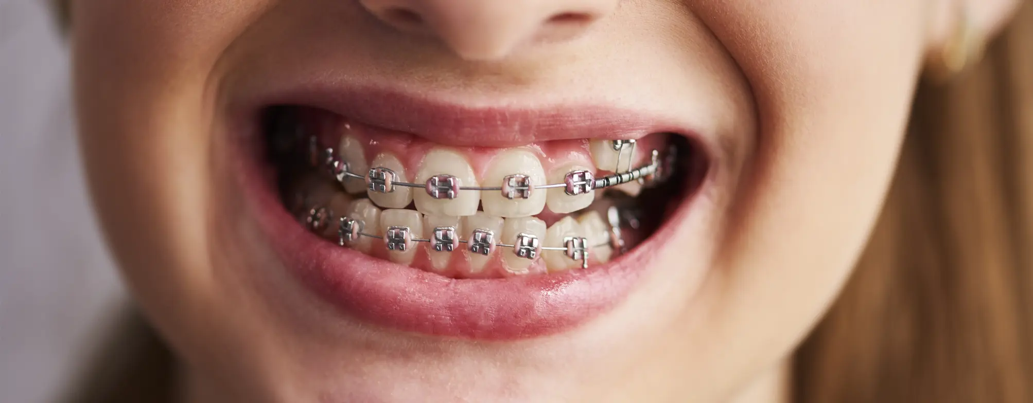can-i-whiten-my-teeth-while-wearing-braces