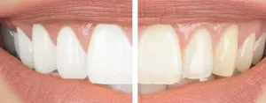 how-white-can-teeth-actually-get