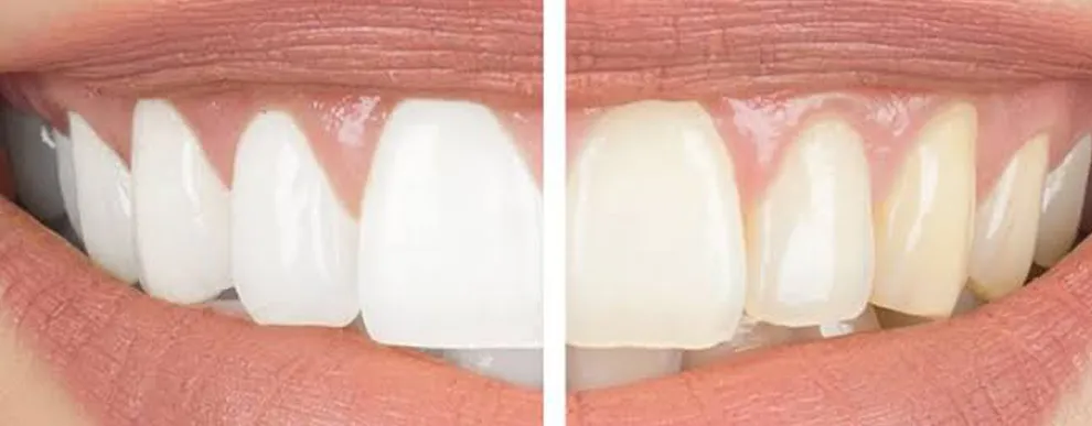 how-white-can-teeth-actually-get
